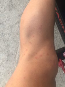 Emily's bug bites from Everglades